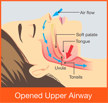 Open upper airway